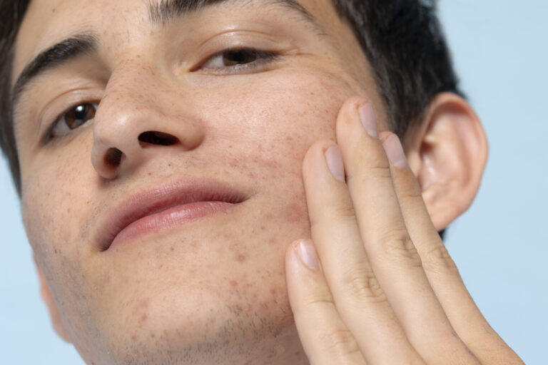 Effective Tips for Managing Acne: A Comprehensive Guide
